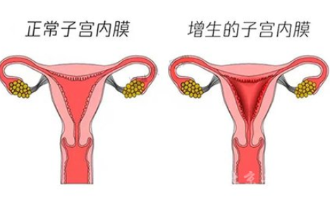 白带常规香蕉视频黄污下载厂家解读子宫内膜增生是什么原因引起的