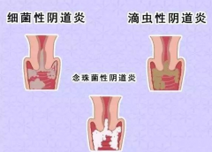 全自动阴道分泌物香蕉视频黄污下载厂家提醒您还在拖延吗，还在等阴道炎自愈吗？